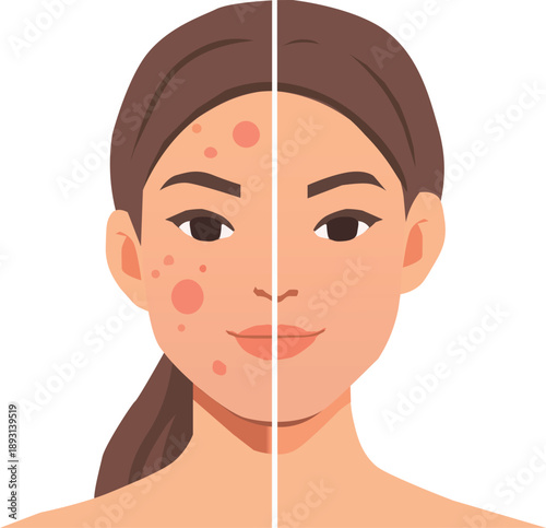 Before and After Acne Treatment Face Comparison Flat Vector Illustration