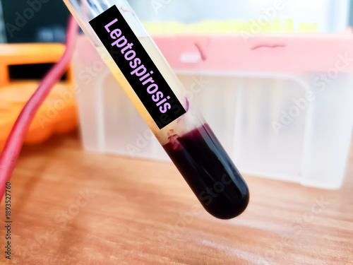 Schilderij op canvas Blood sample for Nipah virus and Ham test conceotional image.