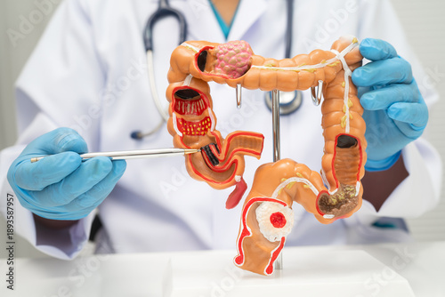 Canvas-taulu Colorectal cancer, doctor holding intestine colon human model.