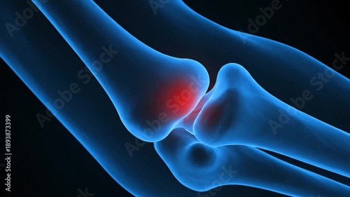 Elbow Joint Pain Xray Animation.