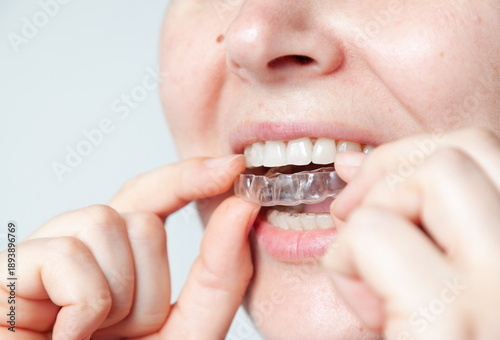 Caps for teeth after braces hold bite in desired position