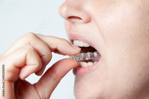 Capa after removal of braces to fix result of treatment