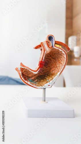 Medical model showing GERD and acid reflux in stomach.