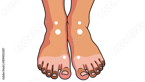 Human Feet with Sunburn and White Spots Vector Illustration, Skin Condition Concept, Medical Health Graphic