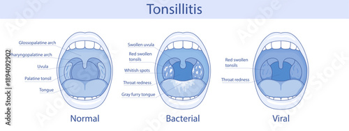 Medical anatomical illustration. Tonsillitis can be bacterial or viral in nature. Infection of the tonsils. Open mouth, anatomy.