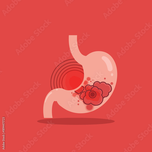 Stomach Anatomy Illustration with Cancerous Tumors and Pain