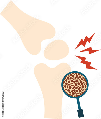 Osteoporosis Illustration