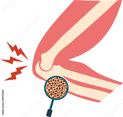 Osteoporosis Illustration