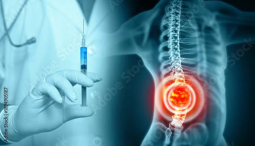 Tableau sur toile 3d illustration of a lumbar spine injection, cancer treatment