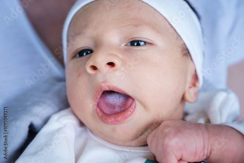 Baby showing a visible white, creamy layer on tongue and inside mouth, indicating oral thrush or candidiasis, a common fungal infection affecting infants and newborns