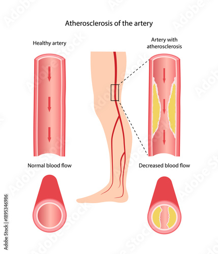 Artery atherosclerosis. Medical illustration of a healthy artery and one affected by atherosclerosis. Vector illustration of a longitudinal and cross-sectional artery in flat style