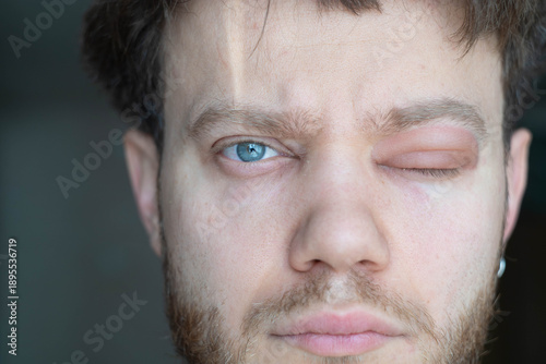 Schilderij op canvas A man with an eye allergy, angioedema, swelling