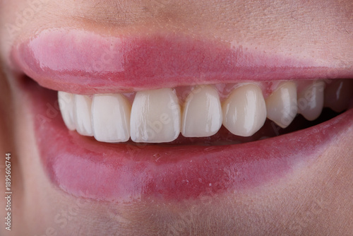 Photos Female smile makeover by dental ceramic veneers, porcelain laminate veneers