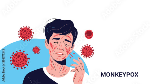 Medical illustration of a man showing symptoms of monkeypox with red rashes and virus cell icons in the background.