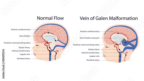 Vein of Galen malformation
In the malformation, abnormal arteriovenous connections form a dilated venous pouch causing high-flow shunting and venous pressure.
It is a rare congenital condition in neon