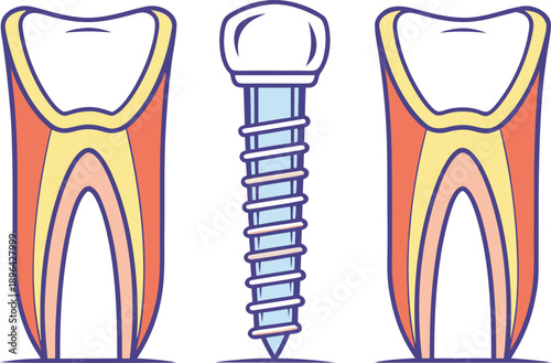 Medical Implant Design Illustration. Dental Implant Design Concept. Surgical Implant Medical Illustration. Orthopedic Implant Design Illustration. Healthcare Implant Medical Design. Modern Medical Imp