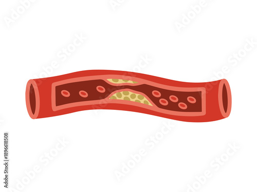 Hand Drawn Cholesterol in Artery 