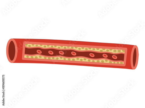 Cholesterol Artery Blockage Symptoms
