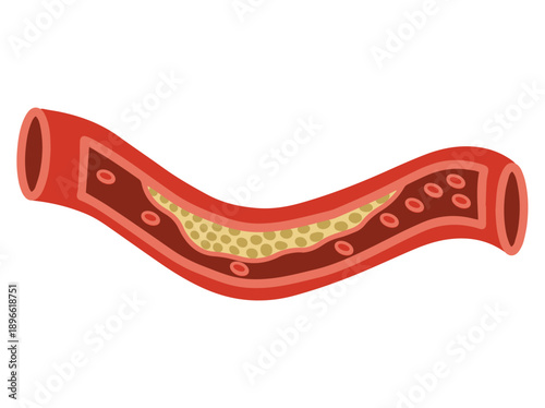 Blood Vessel or Artery with Cholesterol