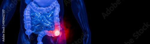 Colon Cancer Anatomy Illustration Showing Tumor in Large Intestine and Digestive System for Medical and Healthcare Use 3D Rendering
