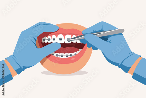 Orthodontist hands installing dental braces on a patient's open mouth and teeth