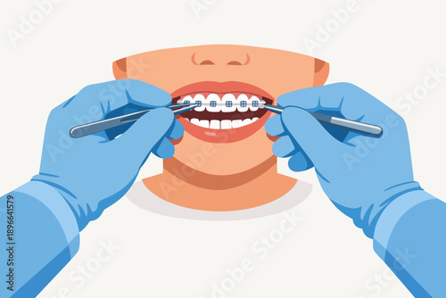 Hands in blue gloves and dental tools adjusting braces on a patient's open mouth