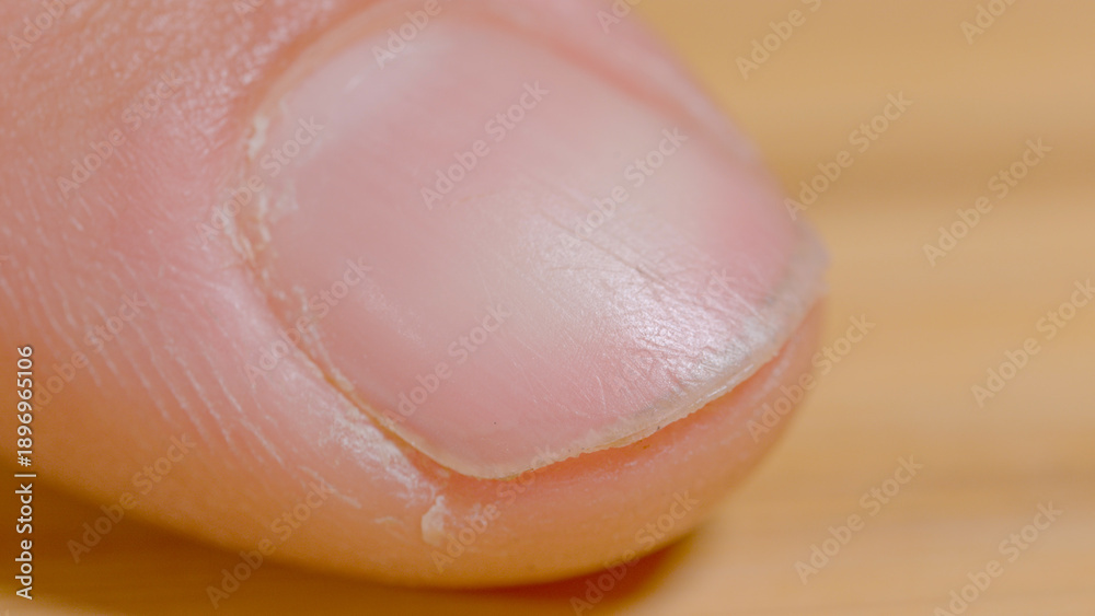 Αυτοκόλλητο MACRO: Detailed shot of a hard-working person's cracked skin of their fingers
