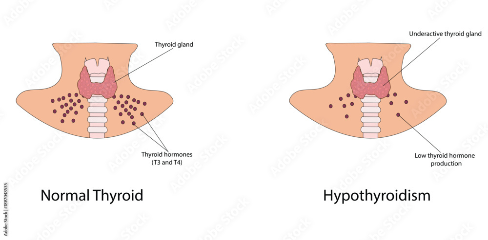 Obraz premium Hypothyroidism vector illustration