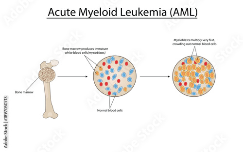 Acute myeloid leukemia (AML) vector illustration