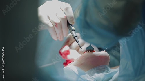 Surgical procedure highlights: closeup precision in medical operation Umbilical hernia removal.