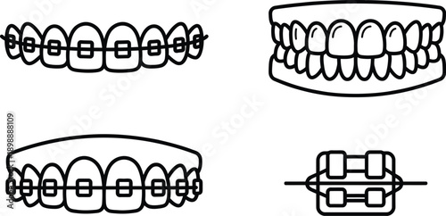 Orthodontic braces on human teeth for dental alignment illustration