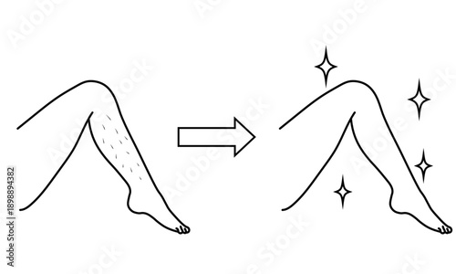 脚の脱毛　ビフォーアフターイラスト