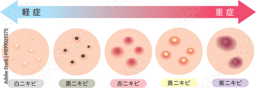ニキビの炎症度の過程