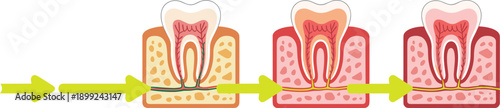 Progressive stages of dental disease infographic showing tooth decay, gum recession, pulp infection, and bone loss from healthy to severe periodontitis