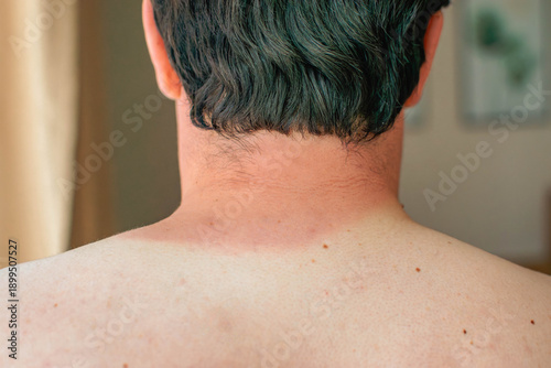 Tableau sur toile close-up of man’s neck with distinct sunburn line and bare back
