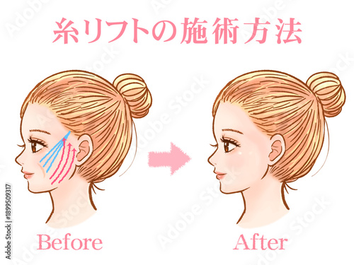 美容整形で糸リフト受ける大人女性の素材