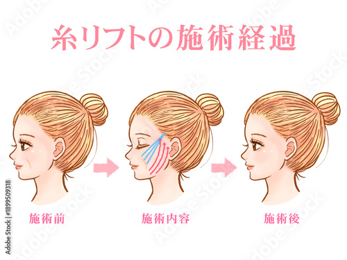 美容整形で糸リフト受ける大人女性の素材3