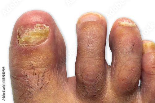 toenail fungus with onychomycosis at peak Infection in fungal foot nail