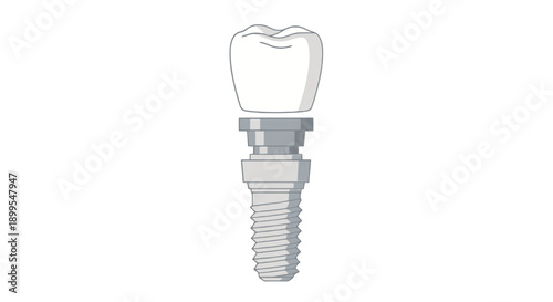 Dental Implant Illustration Showing Tooth and Screw Mechanism