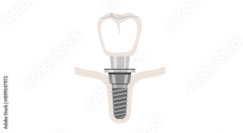 Dental Implant Illustration Showing Tooth Structure and Jawbone