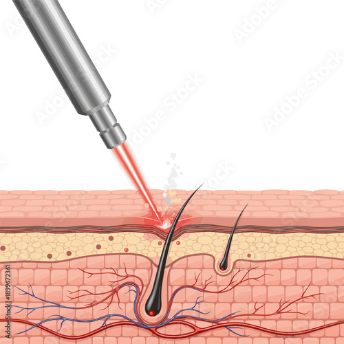 Isolated a realistic Cosmetic Laser Beam Treatment on Skin Layer Background, 3D Illustration vector art with white background..