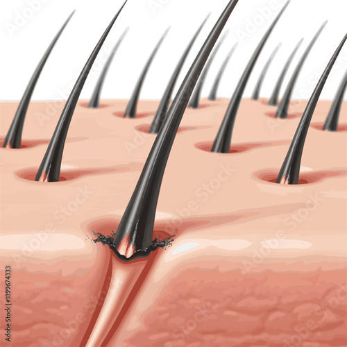 Isolated a realistic Laser burns hair roots, ensuring effective hair removal process. 3D rendering vector art .