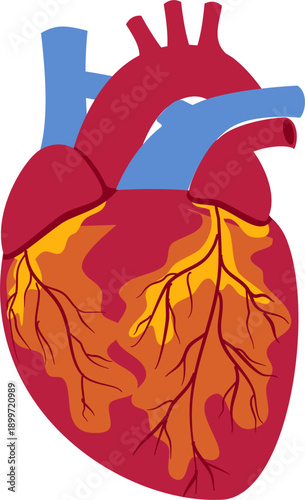 Coronary artery disease medical illustration. Heart blockage and atherosclerosis vector