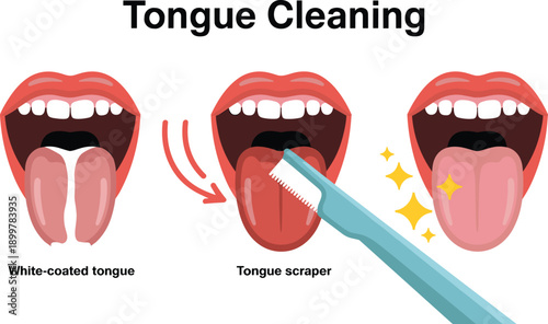 Tongue cleaning medical illustration showing white coated tongue treatment with scraper for oral hygiene fresh breath and dental health care