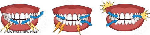 Types of bruxism dental illustration showing teeth clenching grinding and tapping with blue movement arrows and orange pain signals on white
