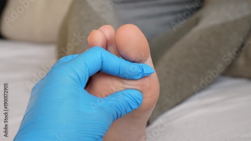 Dermatologist wearing gloves examines and palpates woman's foot with calluses, common warts, and corns. Verruca vulgaris, flat wart on foot. Human papillomavirus. HPV