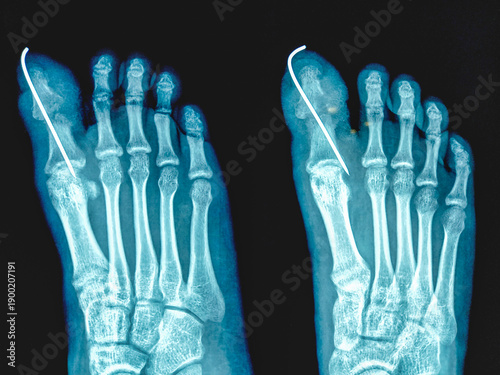 Tableau sur toile X-ray of human foot