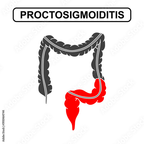 Illustration of proctosigmoiditis ulcerative colitis. Inflammation of the human digestive system. Inflammatory bowel disease, Inflammation of the human digestive system. Medical Vector illustration.