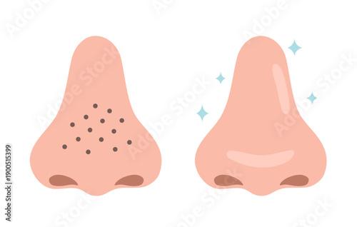 Before and after comparison of a darkened nose with blackheads and a nose that has become beautiful after skin care.