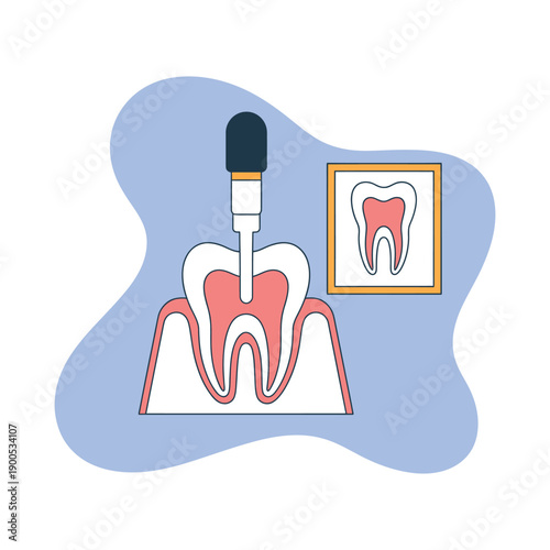 A dentist uses a specialized tool to examine a tooth with a visible pink pulp and white enamel on a blue background.